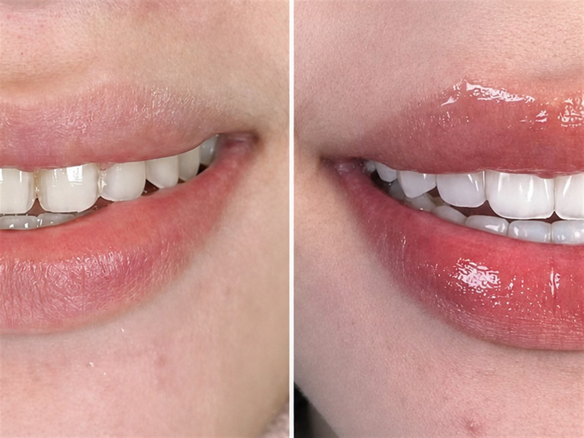Before and after porcelain veneer case showing natural smile refinement